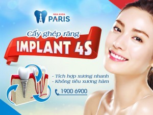 Cấy ghép răng implant 4S đảm bảo phục hình răng mất tốt nhất - ảnh